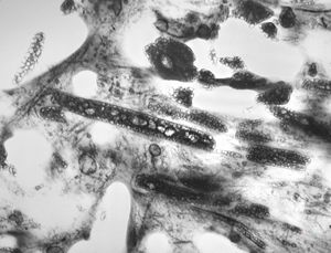 M,67y. | pseudogout - pyrophoshate arthropathy